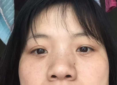 去眼袋手术