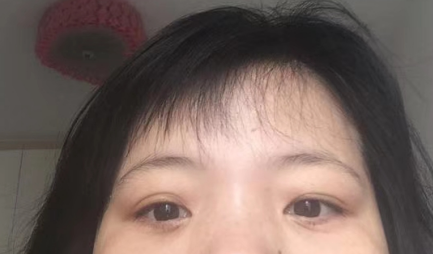 去眼袋手术
