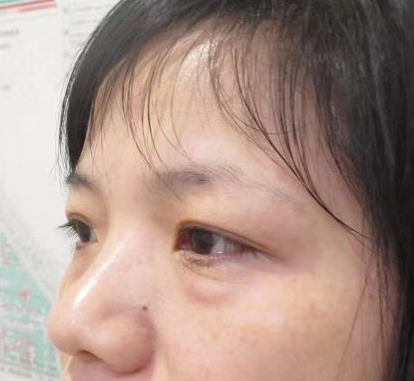 去眼袋手术