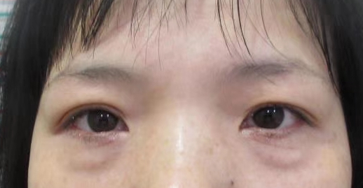 去眼袋手术