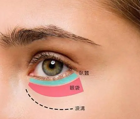 去眼袋手术