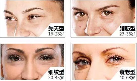 去眼袋手术