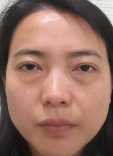 去眼袋手术