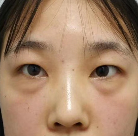 去眼袋手术