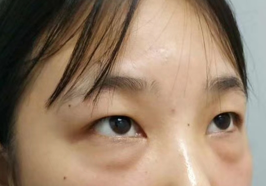 去眼袋手术