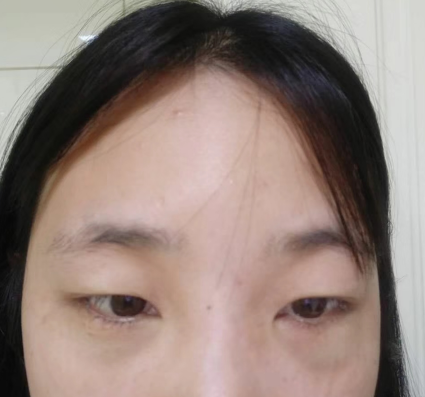 去眼袋手术