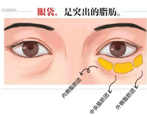 去眼袋手术