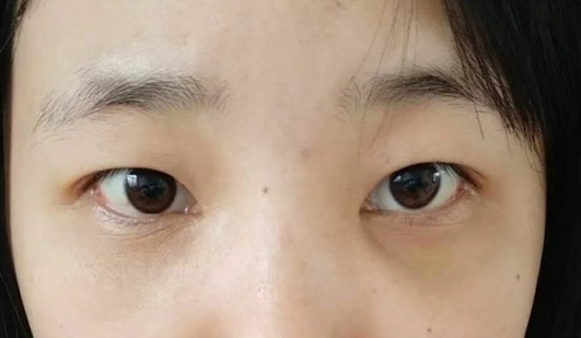 去眼袋手术