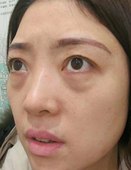 去眼袋手术