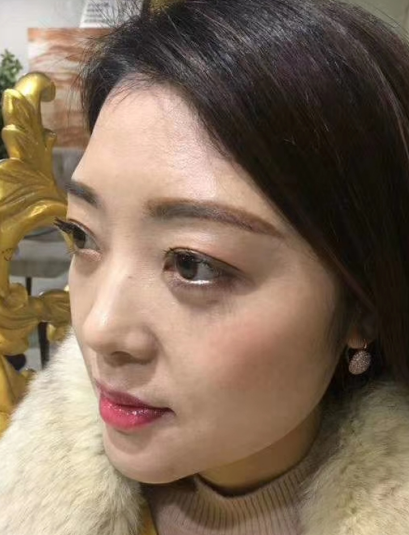 去眼袋手术