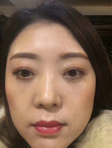 去眼袋手术
