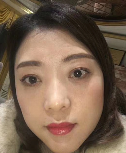 去眼袋手术