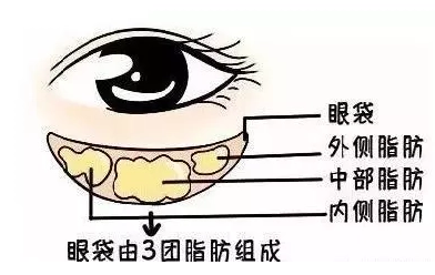 去眼袋手术