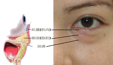 去眼袋手术
