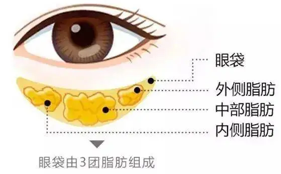 去眼袋手术