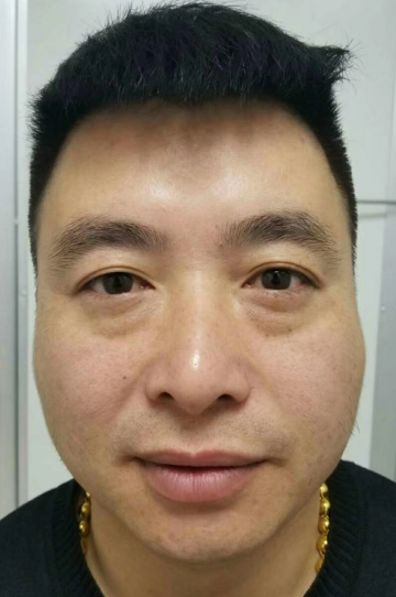 去眼袋手术