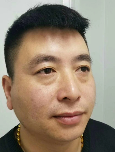 去眼袋手术