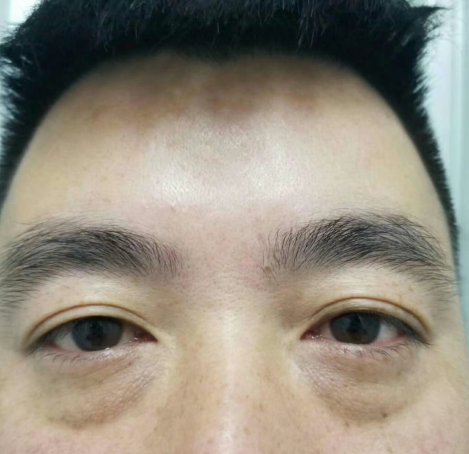 去眼袋手术