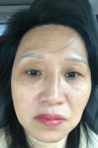 去眼袋手术