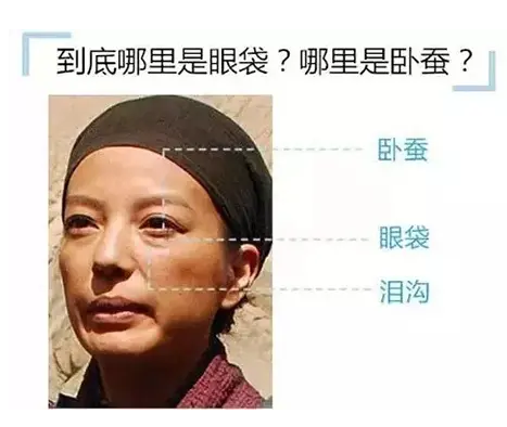 去眼袋手术