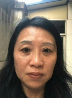 去眼袋手术