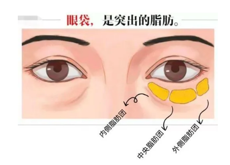 去眼袋手术