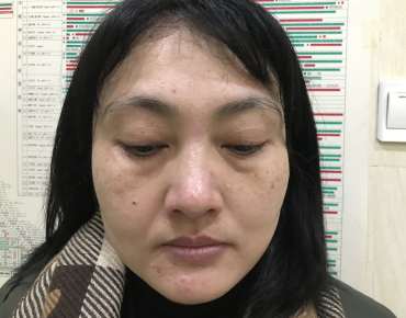 去眼袋手术