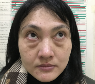 去眼袋手术