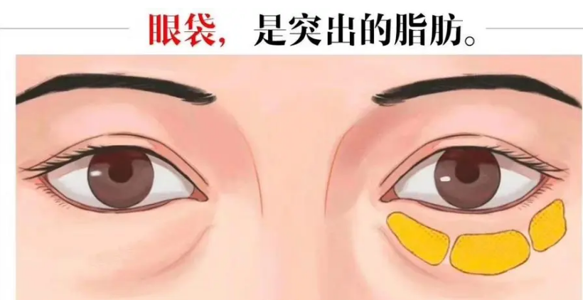 去眼袋手术