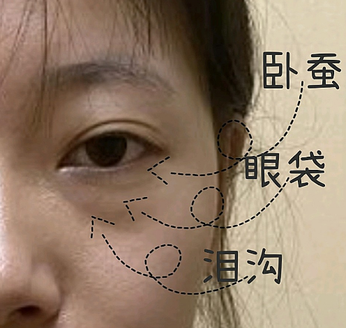 去眼袋手术