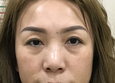 眼袋手术有哪些风险?怎么避开?907 眼袋手术有哪些风险?怎么避开?907