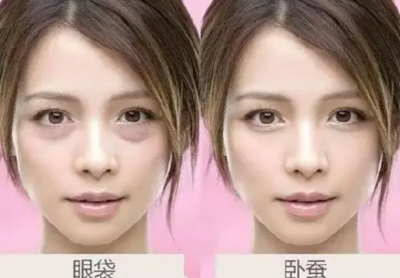 去眼袋手术
