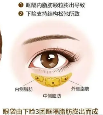 去眼袋手术