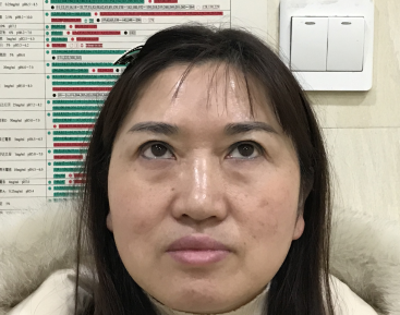去眼袋手术