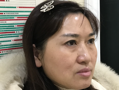 去眼袋手术