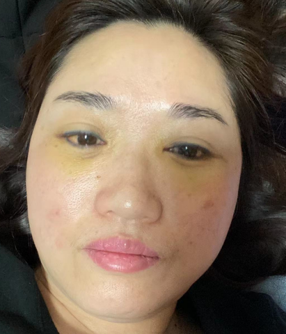 去眼袋手术