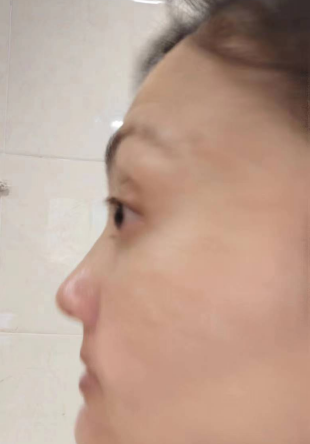 去眼袋手术