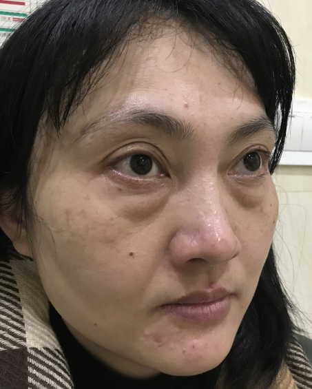 去眼袋手术