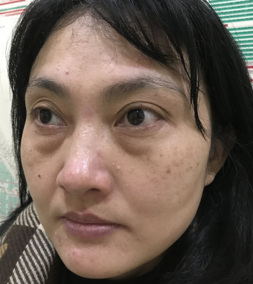 去眼袋手术