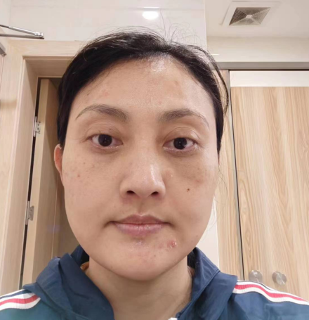 去眼袋手术