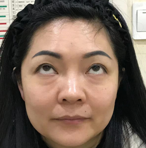 去眼袋手术