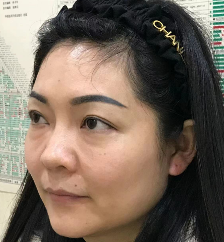 去眼袋手术