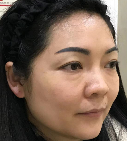去眼袋手术