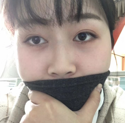 去眼袋手术