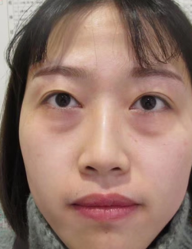去眼袋手术