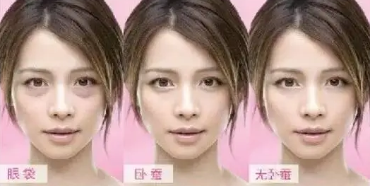 去眼袋手术