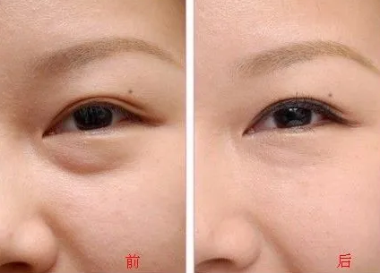 去眼袋手术
