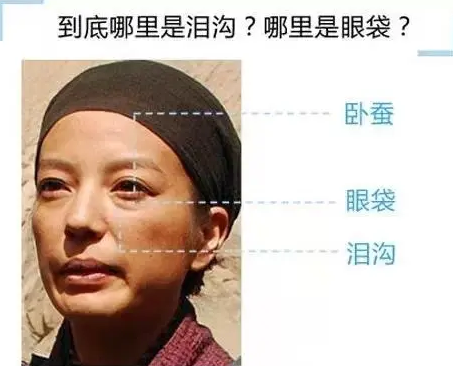 去眼袋手术