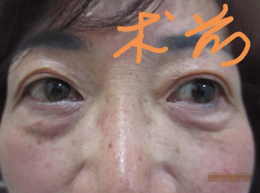 去眼袋手术