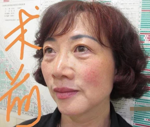 去眼袋手术